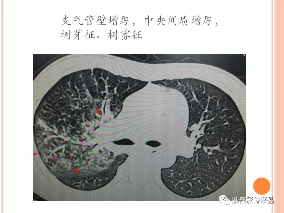 一个医药记者的支原体肺炎笔记